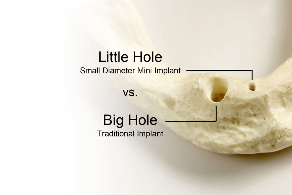 Mini Dental Implant Solutions