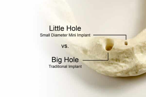 Soluciones en miniimplantes dentales