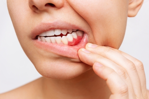 Bleeding Gums in Colorado Springs, CO | Signs of Gum Disease